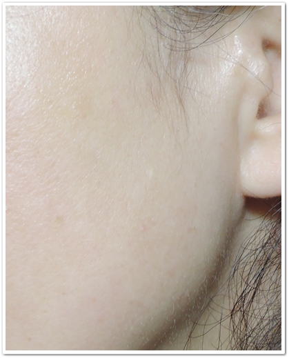 ディオーネ(Dione)顔脱毛体験　10回目から１ヶ月後の左もみあげ効果