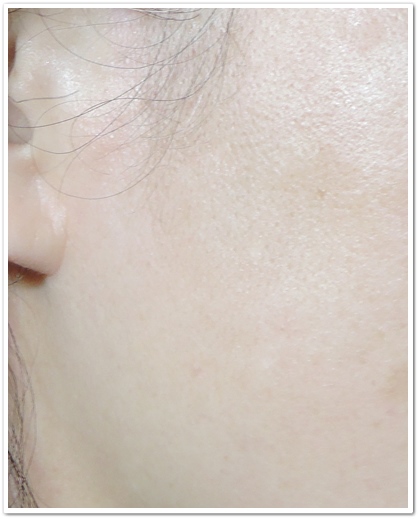 ディオーネ(Dione)顔脱毛体験　10回目から１ヶ月後の右もみあげ効果