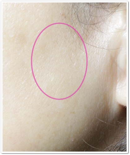 ディオーネ(Dione)　顔脱毛17回目から１ヶ月の左のもみあげ