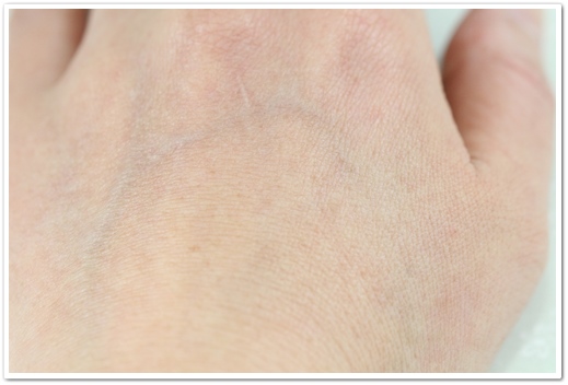 ディオーネ(Dione)首手の甲・指脱毛３回目から１ヶ月後の左手