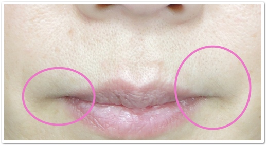 ディオーネ(Dione)顔脱毛19回目から２ヶ月後の鼻の下、口角あたりのムダ毛の状況