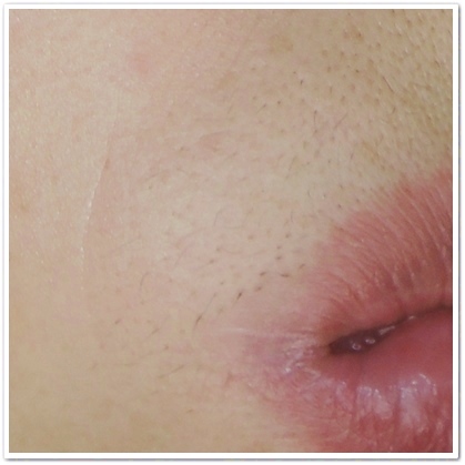 ディオーネ(Dione)顔脱毛19回目から２ヶ月後の鼻の下、口角あたりのムダ毛の状況
