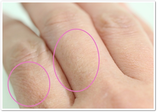 ディオーネ(Dione) 手の指脱毛２回目から２ヶ月後の右の指
