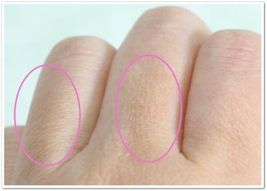 ディオーネ(Dione) 手の指脱毛２回目から２ヶ月後の左の指