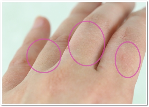 ディオーネ(Dione) 脱毛４回目から１ヶ月後の左手の甲・指